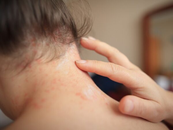 Eczema atópico: saiba como o óleo de prímula pode ajudar